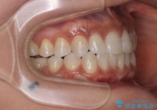 クロスバイトを治したい　インビザラインによる矯正治療の治療後
