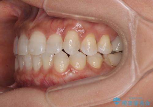 クロスバイトを治したい　インビザラインによる矯正治療の治療後