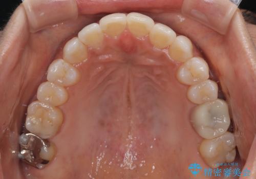 クロスバイトを治したい インビザラインによる矯正治療の治療後