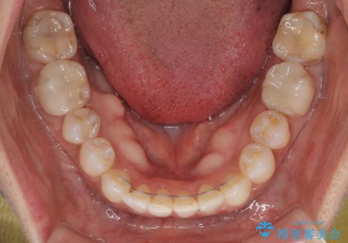 クロスバイトを治したい　インビザラインによる矯正治療の治療後