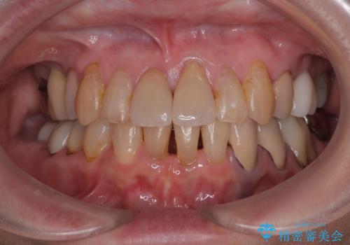 長年気になっていた前歯　矯正治療と補綴治療による審美歯科治療の症例 治療後