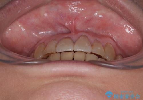 長年気になっていた前歯　矯正治療と補綴治療による審美歯科治療の治療後