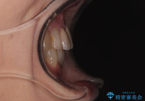 長年気になっていた前歯 矯正治療と補綴治療による審美歯科治療の治療後