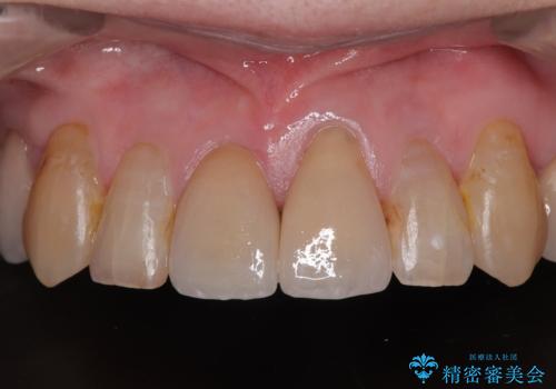 長年気になっていた前歯　矯正治療と補綴治療による審美歯科治療の治療後