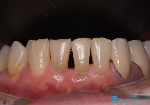 長年気になっていた前歯　矯正治療と補綴治療による審美歯科治療の治療後