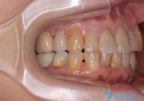 長年気になっていた前歯　矯正治療と補綴治療による審美歯科治療の治療後