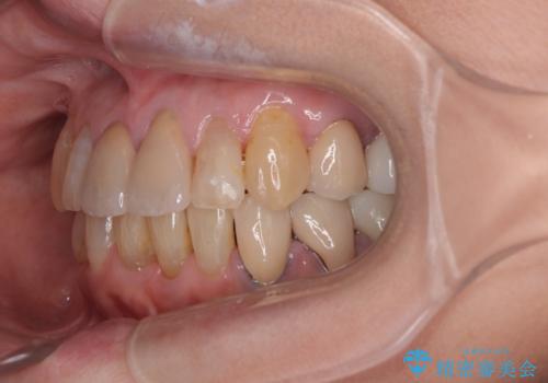 長年気になっていた前歯 矯正治療と補綴治療による審美歯科治療の治療後