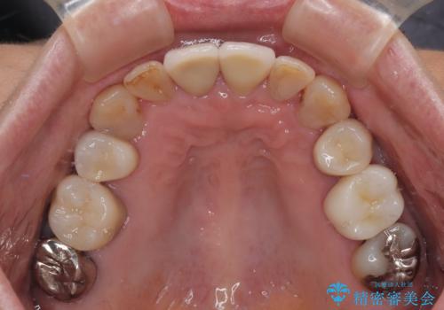 長年気になっていた前歯 矯正治療と補綴治療による審美歯科治療の治療後