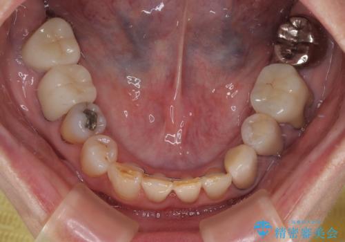 長年気になっていた前歯 矯正治療と補綴治療による審美歯科治療の治療後