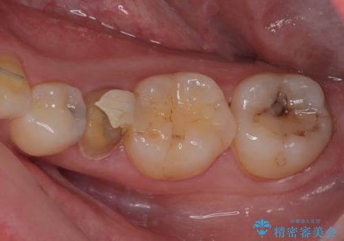 被せものが割れた オールセラミッククラウン・セラミックインレー修復の症例 治療前