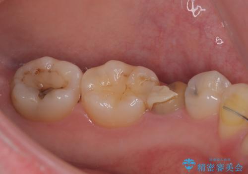 被せものが割れた オールセラミッククラウン・セラミックインレー修復の治療前