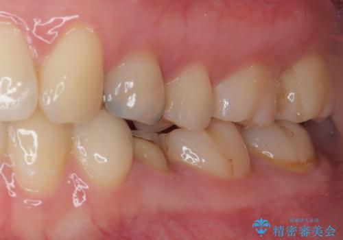 被せものが割れた オールセラミッククラウン・セラミックインレー修復の治療前