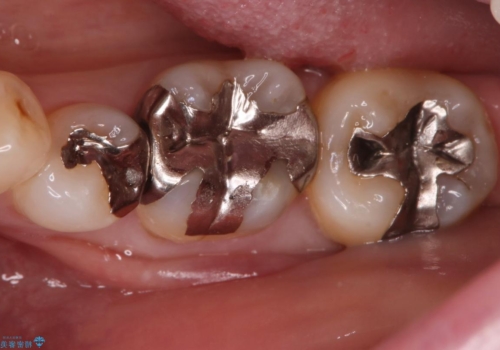 話すときに銀歯が見えて気になる　セラミックでキレイに治す!の症例 治療前