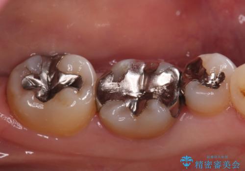 話すときに銀歯が見えて気になる　セラミックでキレイに治す!の治療前