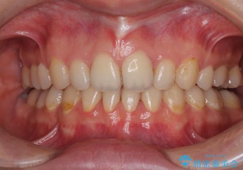 欠損や残存乳歯、深い咬み合わせ ワイヤー矯正で咬合改善の症例 治療後