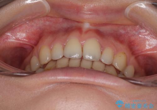 欠損や残存乳歯、深い咬み合わせ ワイヤー矯正で咬合改善の治療後