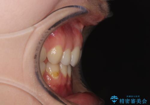 欠損や残存乳歯、深い咬み合わせ ワイヤー矯正で咬合改善の治療後