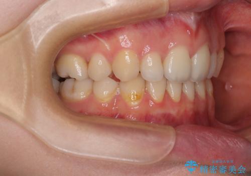 欠損や残存乳歯、深い咬み合わせ　ワイヤー矯正で咬合改善の治療後