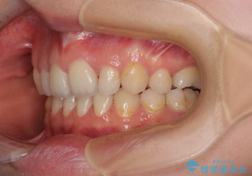 欠損や残存乳歯、深い咬み合わせ　ワイヤー矯正で咬合改善の治療後