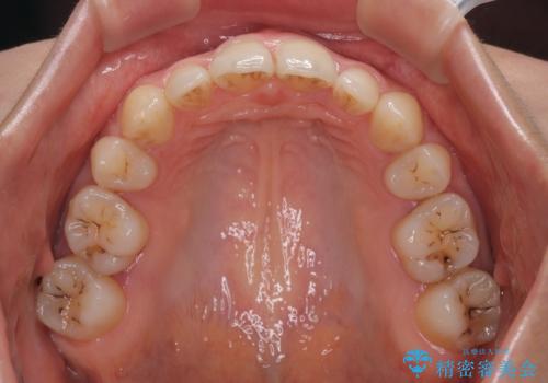 欠損や残存乳歯、深い咬み合わせ ワイヤー矯正で咬合改善の治療後