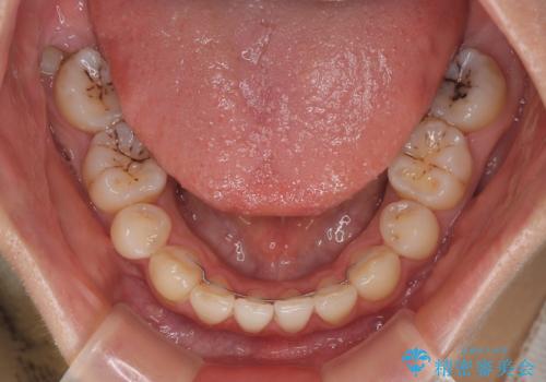 欠損や残存乳歯、深い咬み合わせ ワイヤー矯正で咬合改善の治療後