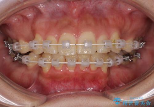 【モニター】唇が閉じにくい ワイヤー装置での抜歯矯正の治療中
