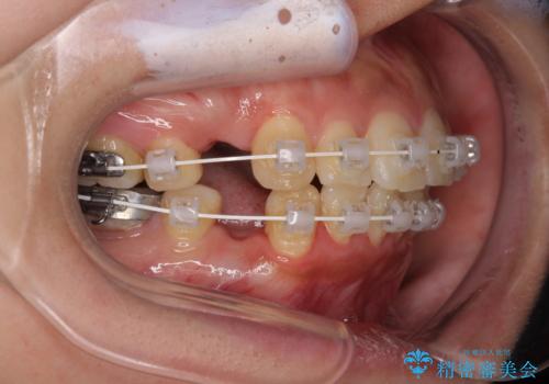 【モニター】唇が閉じにくい　ワイヤー装置での抜歯矯正の治療中