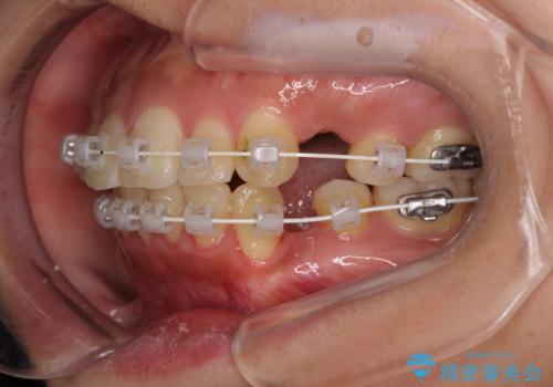 【モニター】唇が閉じにくい ワイヤー装置での抜歯矯正の治療中