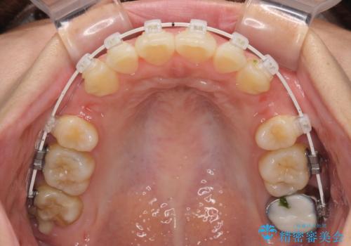 【モニター】唇が閉じにくい　ワイヤー装置での抜歯矯正の治療中