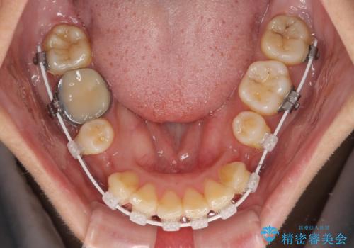 【モニター】唇が閉じにくい　ワイヤー装置での抜歯矯正の治療中