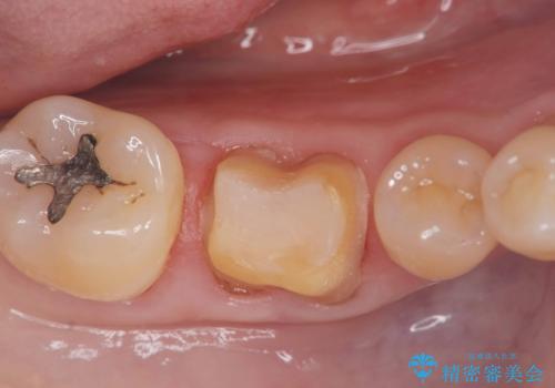 銀歯を白くしたい!|オールセラミッククラウンで審美回復の治療中