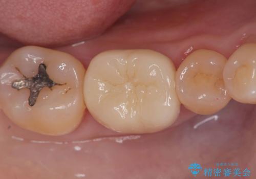 銀歯を白くしたい!|オールセラミッククラウンで審美回復