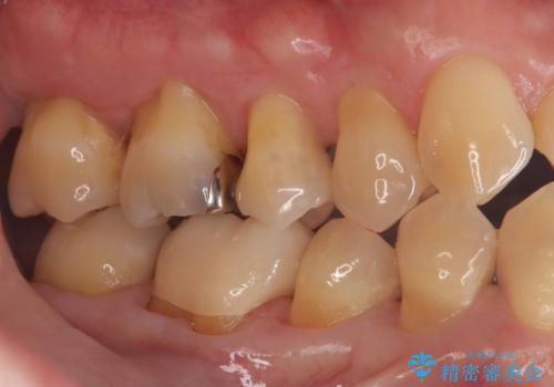 銀歯を白くしたい!|オールセラミッククラウンで審美回復の治療後
