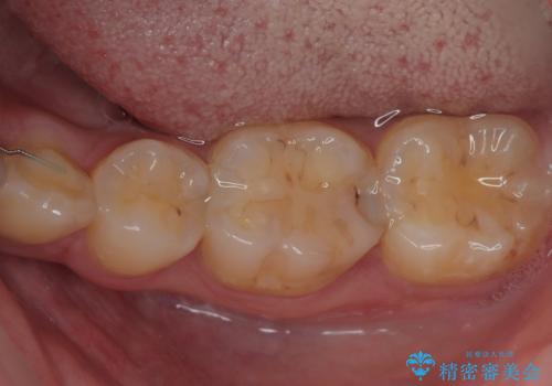 左下が虫歯になっている気がする オールセラミッククラウンの症例 治療前