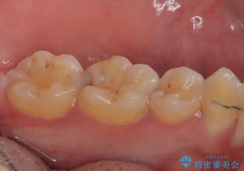 左下が虫歯になっている気がする オールセラミッククラウンの治療前