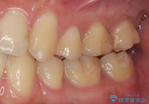 左下が虫歯になっている気がする オールセラミッククラウンの治療前