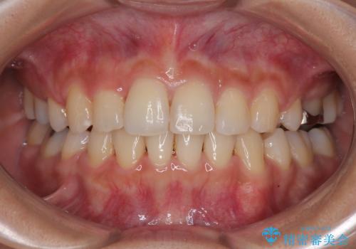 【モニター】閉じにくい前歯とクロスバイト　ワイヤー装置での抜歯矯正の症例 治療後