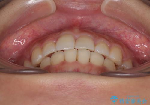 【モニター】閉じにくい前歯とクロスバイト ワイヤー装置での抜歯矯正の治療後