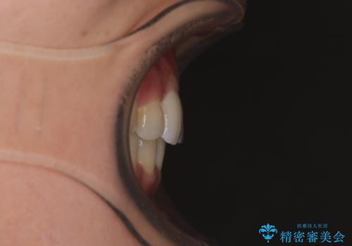 【モニター】閉じにくい前歯とクロスバイト ワイヤー装置での抜歯矯正の治療後