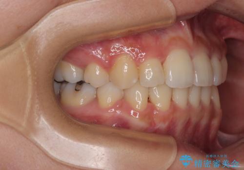 【モニター】閉じにくい前歯とクロスバイト　ワイヤー装置での抜歯矯正の治療後