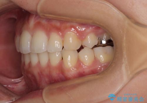 【モニター】閉じにくい前歯とクロスバイト ワイヤー装置での抜歯矯正の治療後