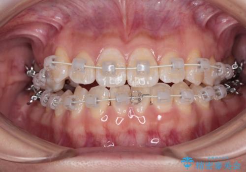 【審美ワイヤー】八重歯とがたつき気になるの治療中