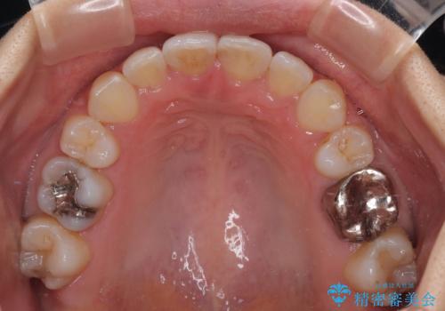 【モニター】閉じにくい前歯とクロスバイト ワイヤー装置での抜歯矯正の治療後