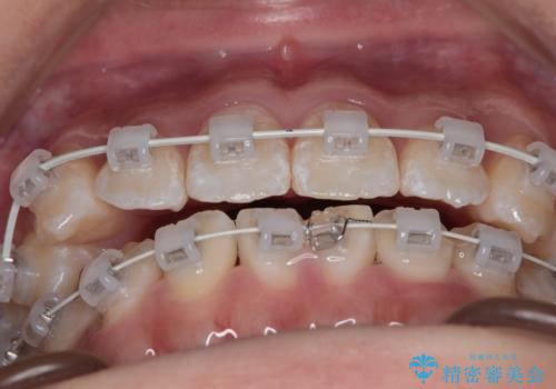 【審美ワイヤー】八重歯とがたつき気になるの治療中