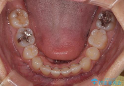 【モニター】閉じにくい前歯とクロスバイト　ワイヤー装置での抜歯矯正の治療後