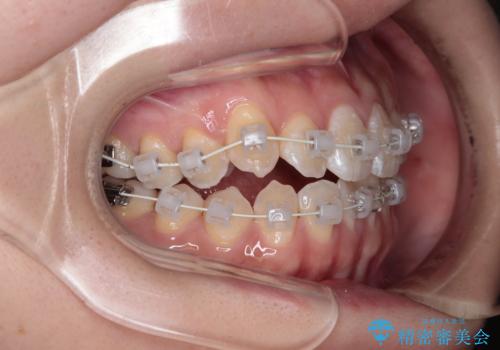 【審美ワイヤー】八重歯とがたつき気になるの治療中