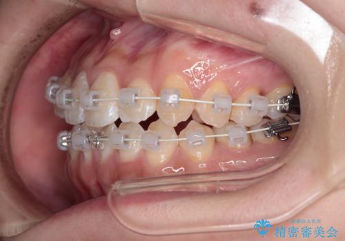 【審美ワイヤー】八重歯とがたつき気になるの治療中