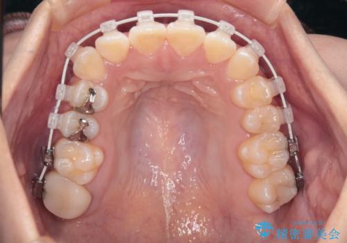 【審美ワイヤー】八重歯とがたつき気になるの治療中