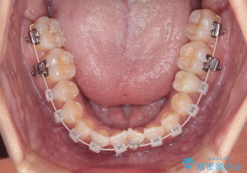 【審美ワイヤー】八重歯とがたつき気になるの治療中