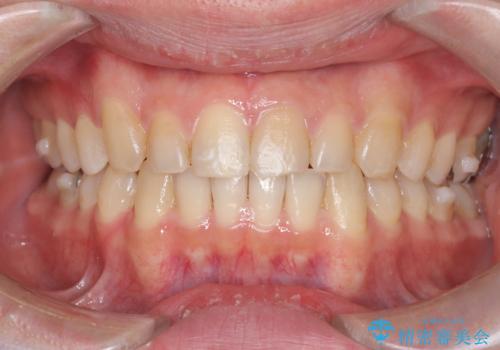 正中離開・クロスバイト・すきっ歯・叢生|インビザラインで治療の治療中